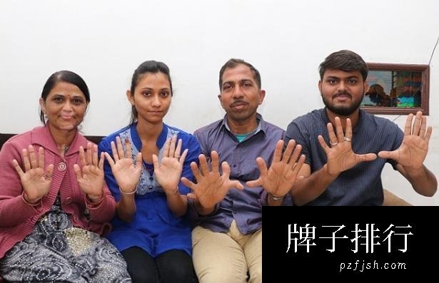 世界指头最多的人 来自印度的木匠有28个指头(患有多指症)